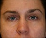 40 year old female with hollowness and puffiness under her eyes treated with fat transfer