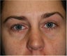 40 year old female with hollowness and puffiness under her eyes treated with fat transfer