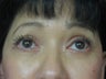 Blepharoplasty, 56 Year Old Female