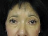 Blepharoplasty, 56 Year Old Female