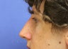Nonsurgical Rhinoplasty with Juvederm Filler to augment the upper nose bridge to mask the dorsal hump.