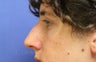 Nonsurgical Rhinoplasty with Juvederm Filler to augment the upper nose bridge to mask the dorsal hump.