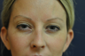 Botox
