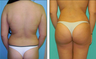 Liposuction Before & After
