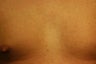 Laser Hair Removal