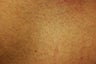 Laser Hair Removal