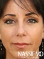 Female Primary Rhinoplasty