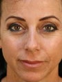Female Primary Rhinoplasty
