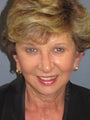LiteLift™, Blepharoplasty, Brow Lift on 57-year-old Woman