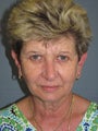 LiteLift™, Blepharoplasty, Brow Lift on 57-year-old Woman