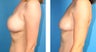 Breast Implant Revision
