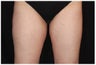CoolSculpting