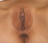 Labiaplasty