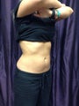 Coolsculpting
