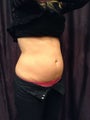 Coolsculpting