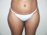 Liposuction
