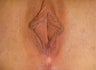 Vaginal Rejuvenation