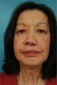 Female treated for adult cleft palate