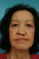 Female treated for adult cleft palate