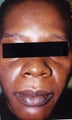 African American Woman 30 to 40 years old with hyperpigmentation