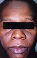 African American Woman 30 to 40 years old with hyperpigmentation