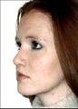 Rhinoplasty