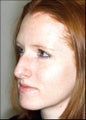 Rhinoplasty