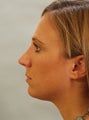 Facial Balance with a Chin Implant