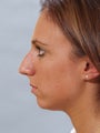Facial Balance with a Chin Implant