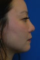 Nose Filler, Nonsurgical Rhinoplasty, Nonsurgical Nose Job, Nose Augmentation