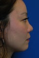 Nose Filler, Nonsurgical Rhinoplasty, Nonsurgical Nose Job, Nose Augmentation