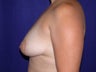 Breast Augmentation