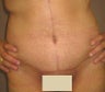 Body Lift