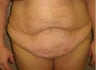 Body Lift