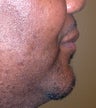 48 Year Old Male Treated For Short Jaw and Sleep Apnea
