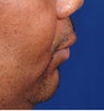 48 Year Old Male Treated For Short Jaw and Sleep Apnea