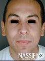Hispanic Male Rhinoplasty