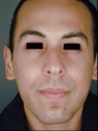 Hispanic Male Rhinoplasty
