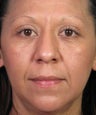 Mole Removal Example from Left Cheek