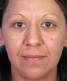 Mole Removal Example from Left Cheek