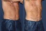 Before & After CoolSculpting -- 6 Weeks
