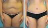Liposuction Before & After