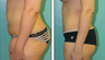 Liposuction Before & After
