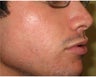 Intense Pulsed Light for Acne
