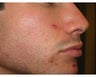 Intense Pulsed Light for Acne