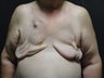 Breast reconstruction - tissue expanders