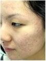 Acne Therapy