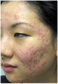 Acne Therapy