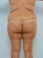 Body Lift