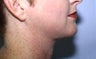 Neck Liposuction